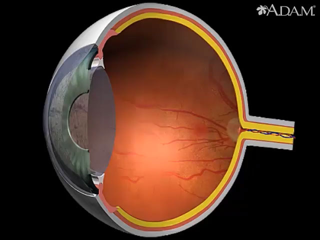 <div class=media-desc><strong>Diabetes - retinal conditions</strong><p>Diabetes may affect the retina by causing the formation of whitish patches called exudates.
Other indications may include tiny enlargements of the blood vessels, resulting in microaneurysms and hemorrhages.
</p></div>