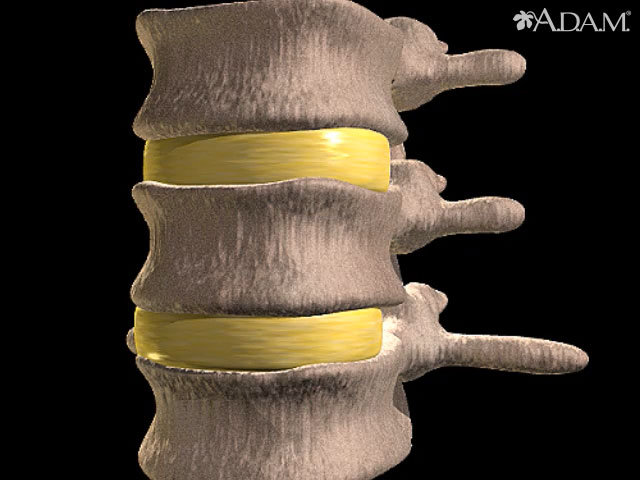 Disc Herniation - Kinetic Labs