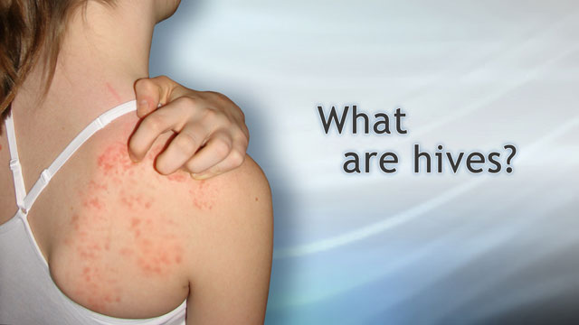can lisinopril cause hives and itching