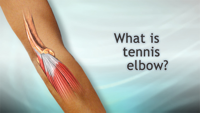 <div class=media-desc><strong>What is tennis elbow?</strong><p>I'm Dr. Alan Greene and let's talk for a moment about tennis elbow. Tennis elbow is a kind of tendonitis. It's an inflammation and injury to the tendons usually on the outside of the elbow. Tendons are those fibrous bands that connect the muscle into the bone. When those tendons get damaged, as they often can in racquet sports or also in baseball, sometimes over using a screwdriver, a lot of ways you can do it, we typically call it tennis elbow or tendonitis. How do you prevent it? When you are playing tennis one of the most important things is to avoid putting too much stress on that tendon on the outside of the elbow. The problem usually comes with your backhand. So if you do a two-handed backhand, you can greatly reduce the stress. You can also reduce the stress by using a racquet that has the right size grip for your hand. Don't play with somebody else's racquet very often. And make sure the strings are not over tightened. It puts too much stress when the ball hits suddenly with over tightened strings. If you have a tendency to get tennis elbow, it could also be very useful immediately after playing to ice the elbow and take some ibuprofen to prevent swelling and inflammation. Now, if you do develop tennis elbow how do you treat it? It comes down to a combination of rest, ice, compression, and elevation. In terms of rest, you want to completely rest your elbow for at least a couple of days and really for as long as it is still sore. In terms of ice that first day, ice very frequently. It's great even every 15 minutes to have an ice pack on there briefly and for the next couple of days, at least every 3 or 4 hours if you can. It will help speed the healing. Wearing a bandage on there to help support the elbow is good. It can also be good when you are playing tennis to help prevent tennis elbow. The wrap on there can help support the elbow and keep it warm and make it less likely to injure. And finally when you are having the severe pain at the beginning especially, keeping your elbow elevated above your heart can help as well and hopefully this will get you back out and physically active again very quickly.</p></div>