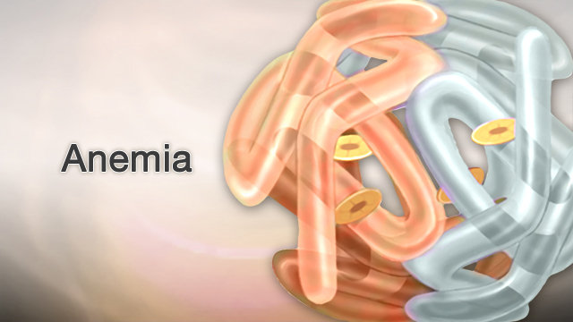 Hemolytic anemia - SmartEngage