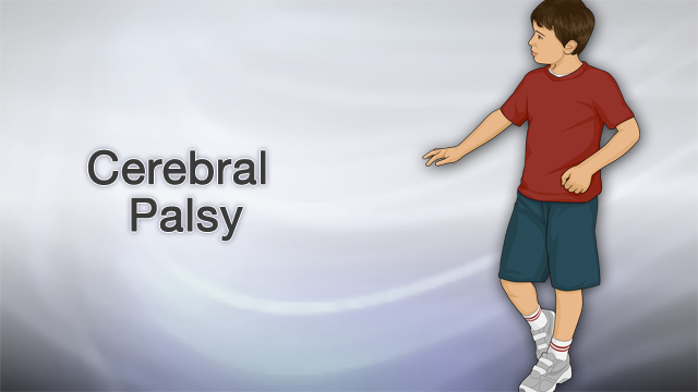 <div class=media-desc><strong>Cerebral palsy</strong><p>The words cerebral palsy or (CP) may conjure up an image of a twisted, wheel chair-bound child. But sometimes the disease is so mild it doesn't limit any activity at all. Let's talk about cerebral palsy. So, what causes cerebral palsy? CP is caused by injuries or abnormalities of the brain. Most of the problems occur as the baby grows in the womb. Premature babies have a slightly higher risk of developing CP. Cerebral palsy may also occur during early infancy as a result of several conditions, including Bleeding in the brain, Brain infections, Head injuries, infections in the mother during pregnancy or from severe jaundice. CP can affect one limb, one side of the body, both arms or legs, three limbs, or all four limbs. The limbs might be floppy, rigid, or spastic. They might have a tremor, move on their own, or be uncoordinated. The limbs might function so well most people would not notice, or they might even be unusable. Children with CP might have normal or superior intellect. Up to a quarter of children with CP have developmental delays or mental retardation. Your child's doctor will do a full neurological exam of your child to verify the symptoms. Tests might include a CT scan or MRI of the head, an EEG, and vision and hearing tests. There is no cure for CP. The goal of treatment is to help your child be as independent as possible. Your child may need a team consisting of a primary care doctor, dentist, social worker, nurses, specialists, and occupational, physical, and speech therapists. A variety of medicines can prevent or reduce the frequency of seizures, help with spasticity, and treat tremors. CP is a lifelong disorder. But with good care it shouldn't get worse over time. CP varies in each individual...your child may need lifelong care, or your child may be able to live independently. It all depends on the severity of your child's CP. Keep in mind that stress and burnout among parents of children with severe CP is common, so make sure that you get the support you need, as well as the support for your child.</p></div>