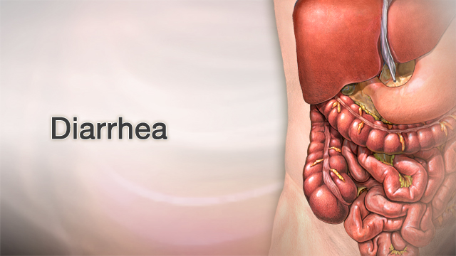 <div class=media-desc><strong>Diarrhea</strong><p>Diarrhea isn't something most people want to talk about, much less have. Not only can diarrhea be uncomfortable, with gas, bloating, and that mad dash to the toilet, but it's a sign that you're either sick, or you've eaten something that really didn't agree with you. With diarrhea, the stools become loose and watery instead of solid. If you have diarrhea, there's a good chance you picked up a stomach virus. Or, you may have gotten food poisoning from eating food or drinking water that was contaminated with bacteria. A lot of people get sick from tainted food while traveling, because they're not used to the food and water in the foreign country. This is called traveler's diarrhea. Certain diseases that affect your intestines can cause diarrhea, including celiac disease, irritable bowel syndrome, Crohn's disease, and ulcerative colitis. If you've taken medications such as antibiotics or laxatives, diarrhea can be an unpleasant side effect. Protect your stomach by giving it healthy bacteria called probiotics. You can find them in yogurt and supplements. Among other things, probiotics help crowd out the bad bacteria that cause diarrhea. To avoid getting sick, wash your hands or use an alcohol-based hand sanitizer so bacteria can't get into your body. And when you travel to areas that may have unclean water, drink only bottled water without ice. Also avoid eating any uncooked fruits or vegetables that don't have a peel. Usually diarrhea goes away by itself pretty quickly, but it can stick around for a few days or even weeks. Loose stools are very watery, and they can dehydrate you pretty quickly. Stay hydrated by drinking at least 8 to 10 glasses of clear liquids a day. Drink one glass every time you have a loose bowel movement. To replace the electrolytes you're also losing with diarrhea, consider an electrolyte drink or rehydration solution. Also you may want to eat soup, pretzels, and other salty foods, as well as bananas and other high-potassium foods. Infants and children are especially likely to get dehydrated from diarrhea, and this can be really dangerous. You can tell your baby is dehydrated because his mouth will be dry, he'll make fewer wet diapers, and he won't produce tears when he cries. To keep your child hydrated, give 2 tablespoons of fluid every 30 to 60 minutes. You can use breast milk, formula, broth, or a solution like B.R.A.T. or Pedialyte, which also comes in a kid-friendly popsicle form. Diarrhea is an unpleasant, but fortunately short-term affliction most of the time. If it does stick around, call your doctor. The doctor will ask questions about your symptoms, where you've been traveling, and what new medicines you've taken or foods you've eaten. Until you're feeling better, drink plenty of fluids so you don't get dehydrated.</p></div>