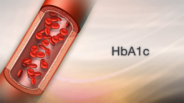 <div class=media-desc><strong>HbA1c</strong><p>If you have diabetes, it's important to keep tight control of your blood sugar. The Hemoglobin A1c test, or HbA1C test, is one way to find out if you are in control. Hemoglobin is an important part of the red blood cell. Red blood cells live about three months. During the life of a red blood cell, sugar molecules, also floating around in your blood, tend to want to stick to the hemoglobin of your red blood cells. Identifying these sugar molecules allows us to get an approximate three-month average of how high persons blood sugars have been. The HbA1c test helps us diagnose a patient suspected of having diabetes and monitors the blood sugar of a diabetic patient. Now, how do we screen for diabetes? If your doctor suspects you have diabetes, your physician will order this simple blood test. A normal HbA1c level is less than 6.0%, which is a three month blood sugar average of around 126 milligrams per deciliter, written like this in your lab results. (126 mg/dl). A HgbA1c level of 5.7 to 6.4% means you are pre-diabetic or borderline-diabetic. If your HgbA1C is 6.5% or higher, you are considered to be a diabetic. That correlates roughly to a 3-month blood sugar average of 140. So, if you are a diabetic, what level should your HbA1c be? Through a combination of a good diabetic diet that controls for carbohydrates, proteins, fats and calories, the American Diabetes Association currently recommends a HbA1C goal of less than 7%. I should also point out that the American Association of Clinical Endocrinologists recommends an even stricter control of diabetes - with a recommended goal of less than 6.5%. What we do know is diabetes causes permanent and irreversible damage to the nerves, blood vessels and body organs, like your eyes, kidneys, heart and also your feet. So, it's critical to get and keep your diabetes under good control to avoid serious long-term health problems. People often ask -- How often should a hemoglobin A1C test be done IF you are a diabetic? Since the HbA1c Test reflects 3 months of control, I recommend getting checked every 3 months to let you, and your doctor know how you're doing. Remember, if you have diabetes, keeping good control of your blood sugar reduces your risk for long-term health problems, like Eye, heart, kidney problems, and even stroke. See your doctor for HbA1c tests every 3 months; you'll be glad you did.</p></div>