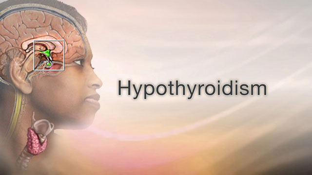 <div class=media-desc><strong>Hypothyroidism</strong><p>Do you feel tired and weak? Well, there could be many reasons for that, but a slow, underactive thyroid may be your problem. Let's talk about hypothyroidism - also known as Slow Thyroid. Here's the thyroid. It's this butterfly shaped gland in your neck - just below the voice box. The thyroid gland is known as the master gland of the body. It regulates our metabolism, so we don't act slow, like turtles, or fast, like jackrabbits. This gland releases hormones that control many important things, like helping your heart pump blood, stimulating your brain and muscles, and helping you keep your body at a healthy temperature. When you have hypothyroidism, your thyroid gland does not make enough hormone, so you end up feeling a bit slow, and perhaps cold, like the turtle. So, what causes a slow thyroid? For at least 9 out of 10 folks, the cause is something called Hashimoto's thyroiditis -- It's what we call an autoimmune condition, where, for reasons that we don't quite understand, our own body attacks perfectly good thyroid tissue as though it were a foreign invader. This attack damages the thyroid gland, so much, that it can't put out enough hormone. This attack happens much more often in women than in men, 10 and 20 times more often. Also, some women develop this condition soon after pregnancy, Why that happens? Nobody knows for sure! So, how do you feel if you have a slow thyroid? If it's just mildly slow, you might not feel anything at all, that's called subclinical hypothyroidism. On the other hand, you might be experiencing symptoms of a slow thyroid RIGHT NOW, but you just haven't connected the dots. You might have mild fatigue, memory or concentration problems. You may have a decreased sex drive, or have trouble losing weight. If you have hypothyroidism, the main treatment is to use a synthetic form of T4 hormone, called Levothyroxine, that simply replaces what your body isn't producing. After starting hormone replacement, your hormone levels should be checked about every 6 weeks, to make sure you are maintaining normal levels. It's important to remember that treating hypothyroidism does not cure the problem, it only controls it. And once you're on Thyroid hormone replacement, you're probably on it for life. The good news is that once your thyroid situation is properly regulated, you'll probably feel a whole lot better.</p></div>