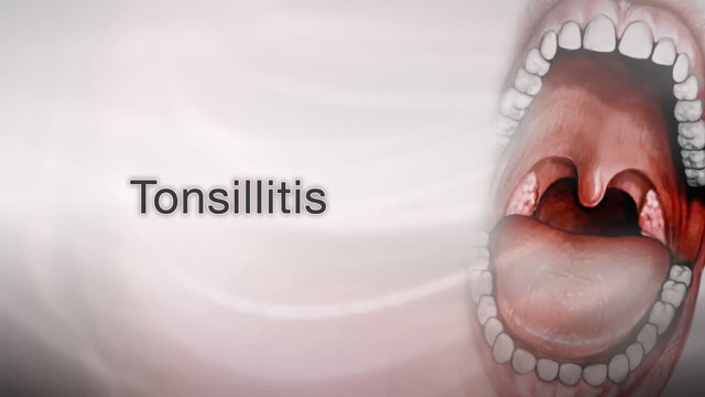 <div class=media-desc><strong>Tonsillitis</strong><p>If your child often has a sore throat, trouble swallowing, and ear pain, she may have a problem with her tonsils. So, what causes tonsillitis? The tonsils are small, dimpled, golf ball-like nodes on either side of the back of your child's throat. They normally help to filter out bacteria and other germs to prevent infection in the body. If the tonsils become so overwhelmed with bacteria from strep throat or a viral infection, they can swell and become inflamed, causing tonsillitis. Your child's doctor will look in your child's mouth and throat for swollen tonsils. The tonsils will probably be red and may have white spots on them. The lymph nodes in your child's jaw and neck may be swollen and tender to the touch. The doctor may test your child's blood for infection. If bacteria are the cause, your child will probably need to take antibiotics, either in a shot or in pill form. If your child needs to take antibiotic pills, make sure she takes all of the medicine. To comfort your child, give her cold liquids and popsicles. Gargling with salt water can help. She can also take over-the-counter medicine like acetaminophen or ibuprofen for her pain and fever. Tonsillitis usually improves two or three days after treatment starts. The infection usually goes away too, but some people may need to take antibiotics for longer. If your child has a great many repeated infections, surgery may be recommended to remove her tonsils, but this is no longer a common reason to have the tonsils out.</p></div>