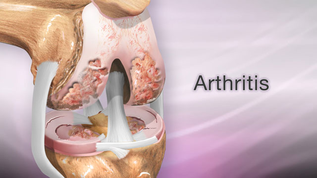 <div class=media-desc><strong>Arthritis</strong><p>Arthritis, inflammation of one or more joints, is the most common cause of disability in the United States, limiting the activities of millions of adults. So, what causes arthritis? Cartilage, which is the tough but flexible tissue that covers the ends of your bones, normally protects and cushions a joint, allowing it to move smoothly. When this covering starts to break down, your bones rub together, causing pain, swelling, and stiffness. This is arthritis. Joint inflammation may result from an autoimmune disease like rheumatoid arthritis, which is when your immune system mistakenly attacks health tissue, or a broken bone, or general wear and tear on joints from osteoarthritis, or an infection from bacteria or a virus. If you have arthritis, you'll probably know it before you see your doctor. You may have joint pain, joint swelling, a reduced ability to move your joint, redness of the skin around your joint, and stiffness, especially in the morning. So, what do you do about arthritis? Your doctor will give you a physical exam and ask questions about your symptoms. Your doctor might find that you have fluid around a joint, warm, red, tender joints, and trouble moving your joints. You may have blood tests and x-rays to check for infection or other arthritis causes. Your doctor may take a sample of joint fluid with a needle and send it to a lab for examination. Once your doctor confirms that you have arthritis, your treatment will focus on reducing your pain, improving your mobility, and limiting further joint damage. Lifestyle changes are a big part of the treatment for arthritis. Exercise can help relieve stiffness, reduce pain and fatigue, and improve muscle and bone strength. Your health care team can help you design an exercise program that is best for you. Physical therapy may also be very helpful. You may use treatments like heat or ice, splints or orthotics to support your joints, water therapy, and even massage. You can take other steps to ease your pain. For example, sleeping 8 to 10 hours a night and taking naps during the day can help you recover from a flare-up more quickly, and may even help prevent them. Avoid staying in one position for too long, and avoid positions or movements that place extra stress on your joints. Install grab bars in the shower, tub, and near the toilet, to help you get around easier. Try stress reducing activities, such as meditation, yoga, or tai chi. Get more fruits, vegetables, cold water fish, and nuts into your diet. Weight loss through dieting and exercise can also take pressure off your joints. After lifestyle factors, medicine can help relieve your arthritis pain. If over-the-counter medicines like acetaminophen, ibuprofen, or aspirin are not enough, your doctor may prescribe stronger medicines. Most forms of arthritis are long-term, and life-long, conditions. But if you make lifestyle changes, and work with your health care team to manage your pain, you should be able to move more freely and hopefully feel less pain.</p></div>