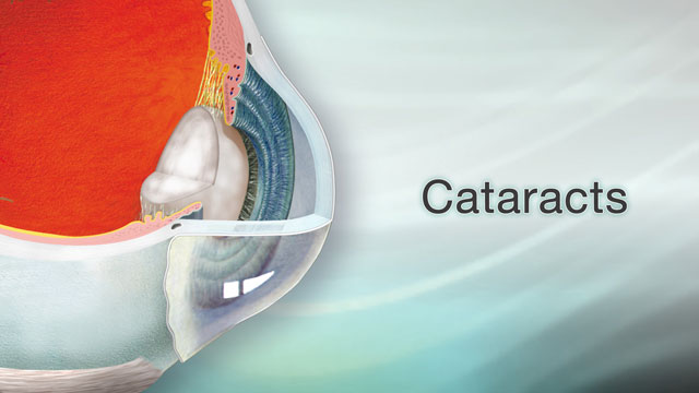 Cataract removal - SmartEngage