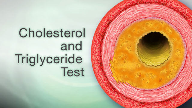 <div class=media-desc><strong>Cholesterol and triglyceride test</strong><p>Maybe you've been eating fast food more often than you should, or you're not getting your recommended two-and-a-half hours of exercise each week. Or, it could be that you smoke, or your blood pressure is too high. Well, for whatever reason, you may be concerned about your risk of getting heart disease. Well, a few tests can help you learn that risk, so you can start making healthy lifestyle changes to reduce it. A coronary risk profile is a group of blood tests that measure your cholesterol and triglyceride levels. Why is it important to know these levels? Because if you have too much of these substances in your blood from eating foods like burgers and French fries, they can clog your arteries. Eventually your arteries can become so clogged that you'll have a heart attack or stroke. Men should have their cholesterol tested by the time they're 35. Women should have it checked by age 45. If you have a condition like diabetes, heart disease, stroke, or high blood pressure, have your cholesterol checked now, no matter what your age. To measure your cholesterol, your doctor will give you a blood test. If you're also having your triglyceride level checked, you may be told not to eat or drink anything for 8 to 12 hours before the test. Depending upon your heart risk, the doctor may measure just your total cholesterol level, or your total cholesterol along with your LDL, or bad cholesterol, HDL, or good cholesterol, and triglycerides. If you're of average risk of getting heart disease, your goal is to have total cholesterol of less than 200 milligrams per deciliter, LDL cholesterol lower than 130 milligrams per deciliter, HDL cholesterol higher than 40 milligrams per deciliter if you're a man, or 50 if you're a woman -- the higher the better, and triglycerides of less than 150 also, the lower the better. Although some illnesses, like arthritis, can raise your cholesterol level, generally having high cholesterol means that you're at increased risk for heart disease and stroke. It's a sign you need to work harder to keep your heart healthy. If your cholesterol levels are normal, that's great! That means that you're eating right, you're exercising, and you're taking good care of your health. You don't need to have another cholesterol test for about five years. But if your cholesterol level is high, or you've already got heart disease, high blood pressure, or diabetes, you'll need to have your cholesterol levels checked more often. Keeping close tabs on your cholesterol and triglyceride levels is one way that you can take charge of your health, and change it for the better.</p></div>