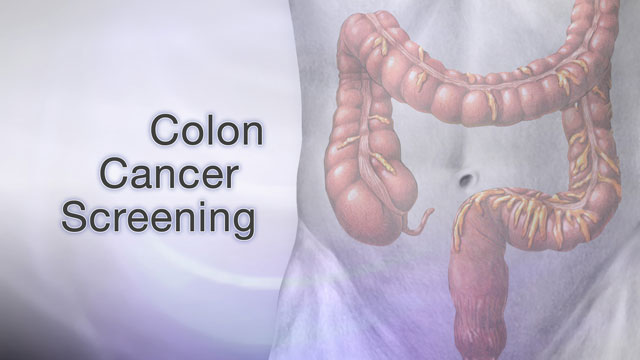 <div class=media-desc><strong>Colon cancer screening</strong><p>Colon cancer is one of the leading causes of cancer-related deaths in the United States. The good news is that early diagnosis through preventive screening often leads to a complete cure. Colorectal cancer starts in the large intestine, also known as the colon. Nearly all colon cancers begin as noncancerous, or benign, polyps, which slowly develop into cancer. Screening can detect these polyps and early cancers. The great thing is that we can remove polyps years before cancer even has a chance to develop! Your doctor can use several tools to screen for cancer. The first step is a stool test. This test checks your bowel movements for blood that you may not even be able to see in your stool. Polyps in the colon and small cancers can bleed tiny amounts of blood that you can't see with the naked eye. The most common method is called the fecal occult blood test. A second method is called a sigmoidoscopy exam. This test uses a flexible scope to look at the lower portion of your colon. But, because it looks only at the last one-third of the large intestine, it may miss some cancers. That's why this test is usually done along with a stool test. A colonoscopy is similar to sigmoidoscopy, but it can see the entire colon. That's why we usually do colonoscopies over sigmoidoscopies nowadays. You'll usually be mildly sedated during this test. Occasionally, your doctor may recommend, as an alternative, a double-contrast barium enema--which is a special x-ray of the large intestine, or a virtual colonoscopy, which uses a CAT scan and computer software to create a 3-D image of your large intestine. So, who should be screened for colon cancer? Well, beginning at age 50, men and women should have a screening test. People with an average risk of colon cancer should have a colonoscopy every 10 years, a double-contrast barium enema every 5 years, or a fecal occult blood test every year. Additional options are sigmoidoscopy every 5 to 10 years. People with certain risk factors for colon cancer may need screening before age 50, or more frequent testing. Such people include those with a family history of colon cancer, African-Americans, those with a history of previous colon cancer or polyps, or folks with a history of ulcerative colitis or Crohn's disease, which are both chronic inflammatory bowel diseases. The death rate for colon cancer has dropped in the past 15 years and this may be due to increased awareness and colon screening. In general, early diagnosis can lead to a complete cure.</p></div>