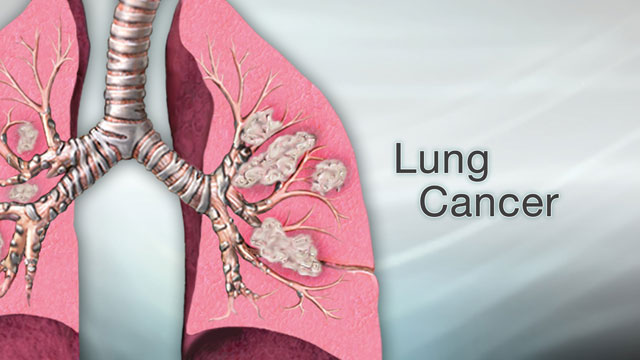 <div class=media-desc><strong>Lung cancer</strong><p>Cancer can affect just about any part of the body, from the colon to the pancreas. Some cancers grow quickly, while others grow more slowly and are easier to treat. But of all the different cancers out there, one of the deadliest is lung cancer. Let's talk today about lung cancer. Cancer starts when cells begin to grow uncontrollably and form tumors. In the case of lung cancer, the tumors start in the lungs. Sometimes cancer starts somewhere else in the body and then spreads to the lungs. In that case, it's called metastatic cancer to the lung. Metastatic means disease that has spread. There are two types of lung cancer. The most common, and slower-growing form is non-small cell lung cancer. The other, faster-growing form is called small cell lung cancer. The most common way to get lung cancer is to smoke cigarettes. The more cigarettes you smoke and the earlier you start smoking, the greater your risk is. Even being around someone who smokes and breathing in the secondhand smoke from their cigarettes increases your risk of getting lung cancer. Even though smoking makes you much more likely to get lung cancer, you don't have to smoke or be exposed to smoke to get the disease. Some people who have lung cancer never lit up a cigarette in their life. They have been exposed to cancer-causing substances like asbestos, diesel fumes, arsenic, radiation, or radon gas. Or, they may not have had any known lung cancer risks. The most common signs of lung cancer are a cough that won't go away, chest pain, shortness of breath, weight loss, and fatigue. But just because you have these symptoms it doesn't mean that you have don't have lung cancer. These can also be signs of other conditions, like asthma or a respiratory infection. If you do have these symptoms, see your doctor. A chest x-ray, MRI, or CT scan can view the inside of your lungs to look for signs of cancer or other diseases. What happens if you do have lung cancer? Doctors divide lung cancer into stages. The higher the stage, the more the cancer has spread. For example, a stage 1 cancer is small and hasn't spread outside of the lungs. A stage 4 cancer has spread to the other organs, such as the kidneys or brain. Depending upon the type and stage of your lung cancer, you may need surgery to remove part or all of your lung. Or, your doctor may recommend radiation or chemotherapy to kill cancer cells. If you have lung cancer, how well you do depends upon the stage of your disease and the type of lung cancer that you have. Early-stage cancers have the highest survival and cure rates. Late-stage cancers are harder to treat. Because lung cancer can be so deadly, prevention is key. The most important that thing you can do is to stop smoking, and avoid being around anyone who does smoke.</p></div>