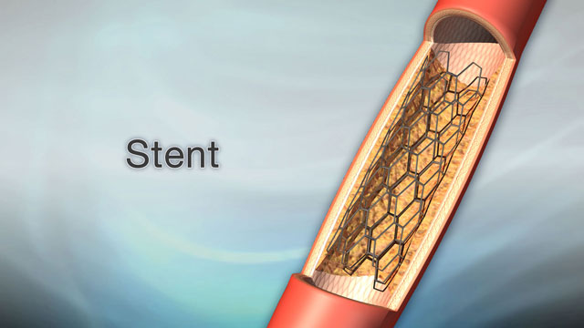 <div class=media-desc><strong>Stent</strong><p>If you have a blocked artery in your heart, legs, or neck, you may need a stent to keep your blood flowing to prevent serious problems. Let's talk today about stents. A stent is a tiny tube we place in an artery, blood vessel, or other duct (such as the one that carries urine) to hold the tubes open. A stent is left in permanently. Most stents are made of metal or plastic mesh-like material. Stent grafts made of fabric are often used in larger arteries. Stents are used to treat a variety of artery and other problems. Your doctor will make a small cut in a blood vessel in your groin and thread a thin, flexible tube called a catheter to the place in your body where you need a stent. In the heart, a fatty substance called plaque can build up inside the coronary arteries. Plaque narrows the arteries, reducing the flow of oxygen-rich blood to the heart. One stent, called an intraluminal coronary artery stent, is a small, self-expanding, metal mesh-like tube that is placed inside a coronary artery after balloon angiography. This stent prevents the artery from re-closing. Another stent is coated with medicine that helps further prevent an artery from re-closing. In the carotid arteries, which are on both sides of your neck, plaque can build up and slow the flow of blood to your brain. Stents can keep the carotid arteries open. Stents can also open up narrow arteries in your legs caused by peripheral arterial disease. They're also used to treat an abdominal aortic aneurysm, which is when the large blood vessel that supplies blood to your abdomen, pelvis, and legs becomes abnormally large and balloons. After a stent procedure, your doctor will probably recommend that you take aspirin and another anti-clotting medication to prevent blood clots from forming in the stent. Make sure that you talk to your doctor, before getting a stent, about the risks associated with placing a stent to treat your condition, such as tissue growing around the area where the stent was placed.</p></div>
