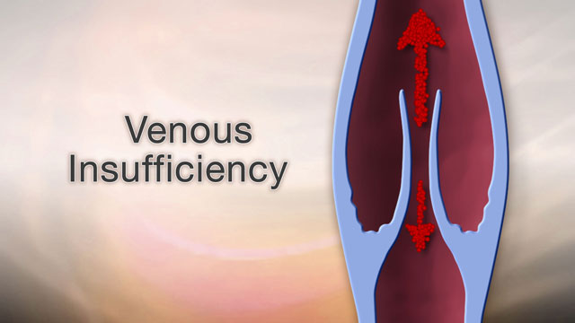 <div class=media-desc><strong>Venous insufficiency</strong><p>If you have dull, aching, or cramping pain in your legs, and pain that gets worse when you stand, you may have a condition called venous insufficiency. In venous insufficiency, the veins in your legs have trouble sending blood back to your heart. Normally, valves in your legs keep your blood flowing back towards your heart so it doesn't collect in one place. But the valves in varicose veins are either damaged or missing. This causes your veins to remain filled with blood, especially when you're standing. A blockage in your vein from a blood clot, called a deep venous thrombosis, can also cause this problem. So, how do you know if you have venous insufficiency? Well, you'll probably feel a dull aching, heaviness, or cramping in your legs. Your legs will swell up when you're on them too long. Your legs may itch or tingle. Pain will get worse when you stand, and better when you raise your legs. Your legs and ankles may also be red. You may notice skin color changes around your ankles. You may see varicose veins on the surface of your legs. You may feel thickening and hardening of the skin on your legs and ankles. So, what can you do about venous insufficiency? Well, your doctor will tell you to use compression stockings to decrease the swelling in your legs. You'll probably have to avoid long periods of sitting or standing. Even moving your legs slightly will help the blood in your veins return to your heart. Walking helps in that same way. Your doctor may recommend surgery or other treatments for varicose veins if you've tried everything and you still have leg pain that feels heavy or tired, skin ulcers or sores caused by poor blood flow. If blood clots are causing you problems, your doctor may prescribe anticoagulant or blood-thinning medicines, to treat existing blood clots and prevent others. Your doctor may suggest you try to keep your legs elevated above your heart when you lie down. You may improve your circulation through exercise. And finally, if you need to lose weight, weight loss can be a very helpful treatment of venous insufficiency and swelling.</p></div>