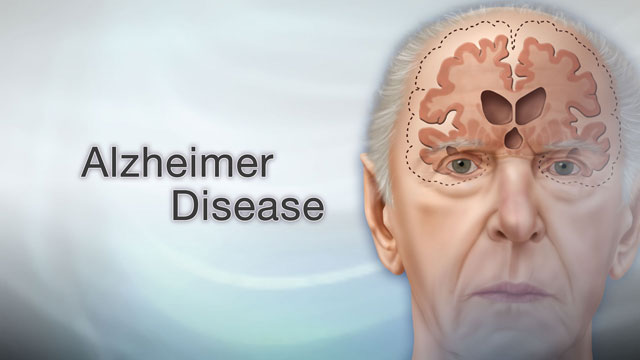 <div class=media-desc><strong>Alzheimer disease</strong><p>Imagine waking up this morning, and not being able to remember your own name, or recognize your spouse? While Alzheimer disease is a more gradual process, over time it can destroy memory to the point where people can't even remember the simplest and most important details of their lives. Let's talk more about Alzheimer disease. Alzheimer disease is a type of dementia, a loss of brain function that makes it harder and harder to think and speak. To understand what causes Alzheimer, we need to look inside the brain. In a normal brain, nerves send messages to one another. In people with Alzheimer disease, abnormal proteins clump in the brain, damaging nerve cells so they can no longer send the messages needed to think clearly. So, why do some people get Alzheimer, and others do not? Getting older itself doesn't cause Alzheimer disease. It's not a part of the normal aging process. Alzheimer does seem to run in families, though. So if you have a close relative, like a sister or parent, with Alzheimer, you may be more likely to get the disease. Usually when Alzheimer disease starts, people have trouble remembering simple things, like their phone number, or where they put their car keys. But, as the disease progresses, memory loss gets worse. People with Alzheimer find it hard to have conversations or complete simple tasks, like getting dressed. They can also become angry or depressed. Those in the later stages of the disease can no longer care for themselves. They lose the ability to recognize even close family members. To diagnose Alzheimer disease, doctors prescribe tests of mental ability. They also prescribe medical tests to rule out diseases that can make it harder to think clearly, such as a brain tumor or stroke. As far as treatments for Alzheimer disease, right now, there isn't a cure. A few drugs can slow memory loss and control depression and aggressiveness from the disease. Despite what you may have read, there isn't any proof that vitamins or other supplements can prevent or treat Alzheimer. However, eating a low-fat diet that's high in vitamin E and C, and rich in omega-3 fatty acids may keep your brain healthier. Alzheimer disease is different in each person. Some people decline quickly and die within just a few years, while others can live for two decades with the disease. If you have a family member with Alzheimer, talk to your doctor about ways to protect your own memory. And, call right away if you have any significant memory loss. Though it may be normal forgetfulness that comes with getting older, the sooner you get it checked out, the earlier you can start treatment if you need it.</p></div>