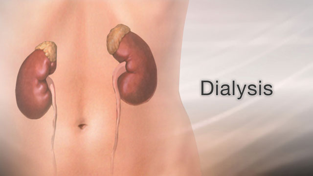 Dialysis - peritoneal | Lima Memorial Health System