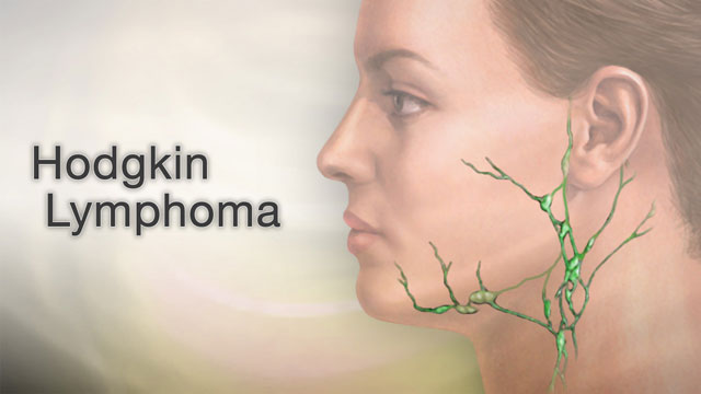 Hodgkin lymphoma Did you ever touch your neck and feel a ...