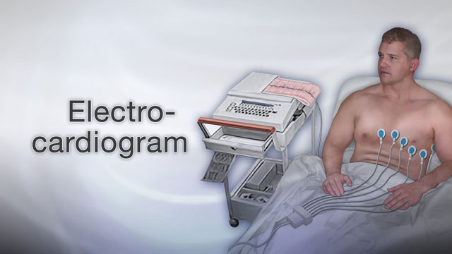 <div class=media-desc><strong>Electrocardiogram</strong><p>If your heart has been beating too fast, or you've been having chest pain, both you and your doctor will want to find out what's causing the problem so you can get it treated. One way to diagnose heart problems is with a test of the heart's electrical activity, called an electrocardiogram or ECG, or EKG for short. Your heart is controlled by an electrical system, much like the electricity that powers the lights and appliances in your home. Electrical signals make your heart contract so that it can pump blood out to your body. Heart disease, abnormal heart rhythms, and other heart problems can affect those signals. Using an ECG, your doctor can identify problems in your heart's electrical system and diagnose heart disease. So, how is an ECG done? First you'll lie down on a table. You'll have to lie very still while the test is done. Small patches, called electrodes, will be attached to several places on your arms, legs, and chest. The patches won't hurt, but some of the hair in those areas may be shaved so the patches will stick to your skin. The patches are then attached to a machine. You'll notice that when the machine is turned on, it produces wavy lines on a piece of paper. Those lines represent the electrical signals coming from your heart. If the test is normal, it should show that your heart is beating at an even rate of 60 to 100 beats per minute. Many different heart conditions can show up on an ECG, including a fast, slow, or abnormal heart rhythm, a heart defect, coronary artery disease, heart valve disease, or an enlarged heart. An abnormal ECG may also be a sign that you've had a heart attack in the past, or that you're at risk for one in the near future. If you're healthy and you don't have any family or personal history of heart disease, you don't need to have an ECG on a regular basis. But if you are having heart problems, your doctor may recommend getting this test. An ECG is pretty accurate at diagnosing many types of heart disease, although it doesn't always pick up every heart problem. You may have a perfectly normal ECG, yet still have a heart condition. If your test is normal but your doctor suspects that you have a heart problem, he may recommend that you have another ECG, or a different type of test to find out for sure.</p></div>