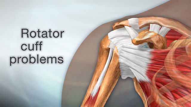 <div class=media-desc><strong>Rotator cuff problems</strong><p>Feeling pain in your shoulder when you lift your arm over your head may mean you have a have a problem with your rotator cuff. So, what causes rotator cuff problems? The rotator cuff is a group of muscles and tendons that attach to the bones of your shoulder joint. The group allows your shoulder to move and keeps it stable. Pain in your rotator cuff area usually means you have rotator cuff tendinitis, or inflammation of these tendons and inflammation of the bursa, smooth slippery sacs the tendons glide across; or a rotator cuff tear, when one the tendons is torn from overuse or injury. Rotator cuff tendinitis may be due to keeping your arm in the same position for long periods of time, such as doing computer work or hairstyling. Sleeping on the same arm each night can also cause this problem. You can also get tendinitis playing sports that require you to move your arm over your head repeatedly, such as in tennis, baseball especially pitching, swimming, and weight-lifting. Rotator cuff tears may happen if you fall on your arm while it is stretched out, or after a sudden, jerking motion when trying to lift something heavy. Chronic tears occur slowly over time, particularly in people who have chronic tendinitis. At some point, the tendon wears down and starts to tear. If you have tendinitis, you'll have pain when you lift your arm over your head, such as when you brush your hair and reach for objects on shelves. The pain may be mild at first, but over time you may have pain at rest or at night, especially when you lie on your shoulder. The pain of a sudden rotator cuff tear can be intense. Your shoulder may be weak, and you may hear a snapping sound when you move your shoulder. Chronic symptoms include a gradual worsening of pain, weakness, stiffness or loss of motion. Most people with rotator cuff tears have worse pain at night and when they wake up. To treat your rotator cuff problem, your doctor will check your shoulder for tenderness and lift your arm to see in which position you have pain. X-rays may show a bone spur, a bony projection. If your doctor thinks you have a tear, you may have an ultrasound or MRI. Treatment for rotator cuff tendinitis involves resting your shoulder and avoiding the activities that cause you pain. You can also try applying ice packs 20 minutes at a time, 3 or 4 times a day. Medicines like ibuprofen may help reduce swelling and inflammation. Eventually, you should start physical therapy to learn to stretch and strengthen the muscles of your shoulder. Surgery can remove inflamed tissue and part of the bone that lies over the rotator cuff, which may help relieve the pressure on your tendons. Someone with a partial rotator cuff tear can try rest and exercise, if they don't normally put a lot of demand on their shoulder. But if there's a complete tear, or if the symptoms don't improve with therapy, you may need surgery to repair the tendon. But with rest or exercise, symptoms of most shoulder problems often improve or go away, though it may take months.</p></div>