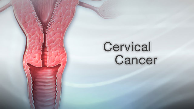 <div class=media-desc><strong>Cervical cancer</strong><p>Worldwide, cervical cancer is the third most common type of cancer in women. Luckily, it's much less common in the United States due to women receiving recommended routine Pap smears, the test designed to find cervical cancer sometimes even before abnormal cells turn to cancer. Cervical cancer starts in the cells on the surface of the cervix, the lower portion of the uterus. There are two types of cells on the surface of the cervix, squamous and columnar. Most cervical cancers come from these squamous cells. The cancer usually starts very slowly as a condition called dysplasia. This precancerous condition can be detected by Pap smear and is 100% treatable. Undetected, precancerous changes can develop into cervical cancer and spread to the bladder, intestines, lungs, and liver. It can take years for these precancerous changes to turn into cervical cancer. However, patients with cervical cancer do not usually have problems until the cancer is advanced and has spread. Most of the time, early cervical cancer has no symptoms. Symptoms of advanced cancer may include back pain, bone fractures, fatigue, heavy vaginal bleeding, urine leakage, leg pain, loss of appetite, and pelvic pain. If after having a Pap smear, the doctor finds abnormal changes on the cervix, a colposcopy can be ordered. Using a light and a low-powered microscope, the doctor will view the cervix under magnification. The doctor may remove pieces of tissue, called a biopsy, and send the sample to a laboratory for testing. If the woman is diagnosed with cervical cancer, the doctor will order more tests to determine how far the cancer has spread. This is called Staging. Treatment will depend on the stage of the cancer, the size and shape of the tumor, the woman's age and general health, and her desire to have children in the future. Early cervical cancer can be treated with surgery just to remove abnormal tissue, freeze abnormal cells, or burn abnormal tissue. Treatment for more advanced cervical cancer may include radical hysterectomy, removal of the uterus and much of the surrounding tissue, including lymph nodes and the upper part of the vagina. Radiation may be used to treat cancer that has spread beyond the pelvis, or if cancer returns. The woman may also have chemotherapy to kill cancer cells. Almost all cervical cancers are caused by human papilloma virus, or HPV. This common virus is spread through sexual intercourse. HPV vaccines can prevent infection. Practicing safe sex also reduces the risk of getting HPV. But, keep in mind most women diagnosed with cervical cancer have not had their regular Pap smears. Because Pap smears can find precancerous growths that are 100% treatable, it's very important for women to get Pap smears at regular intervals.</p></div>