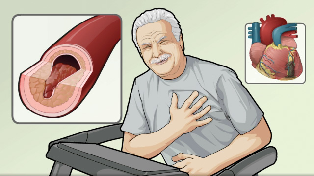 อาการและสาเหตุของโรคหลอดเลือดหัวใจตีบ