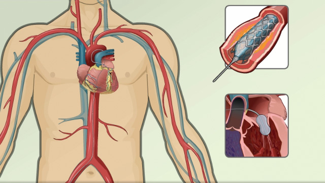 Angioplasty and stent placement - heart | Multimedia Encyclopedia | Health  Information | St. Luke's Hospital