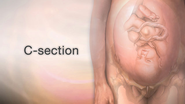 <div class=media-desc><strong>C-section</strong><p>When it's not possible or safe for a woman to deliver a baby naturally through her vagina, she will need to have her baby delivered surgically, a procedure referred to as cesarean section, or C-section. I know this is a controversial topic recently, sometimes people talk C-sections being done too often. That may be true, but when it is necessary, it can be life saving for mother or baby. A C-section is the delivery of a baby through a surgical opening in the mother's lower belly area, usually around the bikini line. The procedure is most often done while the woman is awake. The body is numbed from the chest to the feet using epidural, or spinal, anesthesia. The surgeon usually makes a cut or incision across the belly just above the pubic area. The surgeon opens the womb, or uterus, and the amniotic sac, then delivers the baby. A woman may have a C-section if there are problems with the baby, such as an abnormal heart rate, abnormal positions of the baby in the womb, developmental problems in the baby, a multiple pregnancy like triplets, or when there are problems with the placenta or umbilical cord. A C-section may be necessary if the mother has medical problems, such as an active genital herpes infection, large uterine fibroids near the cervix, or if she is too weak to deliver due to severe illness. Sometimes a delivery that takes too long, caused by problems like getting the baby's head through the birth canal, or in the instance of a very large baby may make a C-section necessary. Having a C-section is a safe procedure. The rate of complications is very low. However, there are some risks, including infection of the bladder or uterus, injury to the urinary tract, and injury to the baby. A C-section may also cause problems in future pregnancies. The average hospital stay after a C-section is 2 to 4 days, and keep in mind recovery often takes longer than it would from a vaginal birth. Walking after the C-section is important to speed recovery and pain medication may be supplied too as recovery takes place. Most mothers and infants do well after a C-section, and often, a woman who has a C-section may have a vaginal delivery if she gets pregnant again.</p></div>