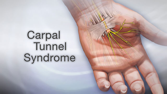 <div class=media-desc><strong>Carpal tunnel syndrome</strong><p>Typing all day on a computer keyboard can be tough on your wrists. If you type for hours at a time, day after day, eventually you may really start to feel some discomfort. The numbness, pain, and tingling you feel in your hands and wrists may be carpal tunnel syndrome, and it can have such a big effect on your life that you may eventually need surgery to treat it. Doing any repetitive motion with your hands, whether it's typing, sewing, driving, or writing, can cause carpal tunnel syndrome. The condition gets its name from an area in your wrist called the carpal tunnel. Running through this tunnel is the median nerve, which sends feeling to your palm and most of your fingers. When you do the same task over and over again, especially flexing and extending the wrist, you put pressure on the median nerve. Over time, it swells up inside the carpal tunnel until it's so tight in there that the nerve gets pinched. The classic symptoms of carpal tunnel syndrome are numbness and tingling in your hand, including the thumb, index, middle, and half of the ring finger. The discomfort is usually worse at night. And anytime you may not be able to grip things as tightly in the affected hand, and you can feel pain that may stretch all the way from the wrist to your elbow. Your doctor can run tests on your hand to confirm that your numbness, weakness, and pain are due to carpal tunnel. You may also have nerve conduction studies, or tests of the muscles. If you're feeling a lot of discomfort from carpal tunnel wearing a wrist splint especially at night could help. In addition, short term oral or injected glucocorticoid medications can help by reducing swelling. Studies have also shown some benefit from physical or occupational therapy techniques, and yoga. About half of the people with carpal tunnel though will eventually need a procedure called carpal tunnel release to lift pressure off the pinched nerve. Surgery is a more permanent solution, but whether it works depends on how severe the nerve damage is, and how long you've had it. You may not be able to completely avoid the repetitive flexing or extending the wrist that gave you carpal tunnel in the first place, especially if it's part of your job. But, you can make some adjustments, for example, by using special devices like a cushioned mouse pad, wrist braces, or a raised keyboard, to relieve the pressure on your wrists. Take occasional breaks whenever you're going to be typing or doing any other repetitive task for long periods of time. And if you are having any numbness, tingling, or pain in your hands or wrists, see your doctor sooner rather than later. Letting carpal tunnel syndrome go untreated could leave you with a permanently damaged nerve.</p></div>