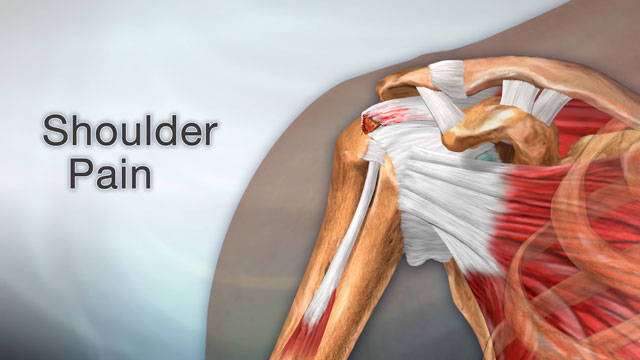 <div class=media-desc><strong>Shoulder pain</strong><p>Swelling, damage, or bone changes around the rotator cuff in your shoulder can cause pain that puts a kink in the activities of your life. Let's talk about shoulder pain. The rotator cuff is a group of muscles and tendons that attach to the bones of your shoulder joint. The group allows your shoulder to move and keep it stable. The most common cause of shoulder pain is when rotator cuff tendons become inflamed or trapped in your shoulder. This is called rotator cuff tendinitis, or irritation of these tendons and inflammation of the bursa, small slippery fluid filled sacs that the tendons glide over. A rotator cuff tear, when one of the tendons is torn from overuse or injury, can also cause intense shoulder pain. Other causes of shoulder pain can include arthritis, bone spurs - bony projections, a broken shoulder bone, frozen shoulder, when the muscles, tendons, and ligaments in your shoulder become stiff, and shoulder dislocation. Most of the time, you can take care of your shoulder pain at home. Try putting ice on your shoulder for 15 minutes, then leave it off for 15 minutes, three or four times a day for a few days. Make sure you wrap the ice in cloth, so it doesn't give you frostbite. Take ibuprofen to reduce pain and swelling. Slowly return to your regular activities once you start feeling less pain. Sudden shoulder pain can be a sign of a heart attack. Call Emergency Services if you have sudden pressure or crushing pain in your shoulder, especially if the pain starts in your chest, jaw, or neck. If you fall on your shoulder and feel sudden intense pain, you should see a doctor because you may have torn rotator cuff or dislocated your shoulder. If you have had shoulder pain before, try using ice and ibuprofen after exercising. Learn proper exercises to stretch and strengthen your rotator cuff tendons and shoulder muscles. Also, physical therapy can help. Make an appointment and talk about your options.</p></div>