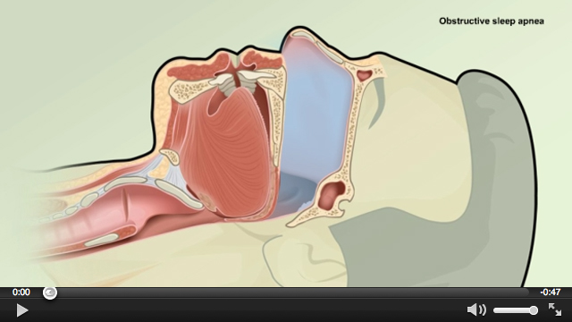 What Is Obstructive Sleep Apnea?