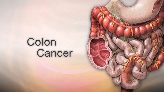<div class=media-desc><strong>Colon cancer</strong><p>Colon cancer may not be talked about as often as other cancers, like breast cancer, prostate or lung cancer, but it's actually one of the leading causes of cancer deaths. It is for this reason it's very important to stay on top of your colon health. The colon is your large intestine, the long, upside-down U-shaped tube that is toward the end of the line for getting rid of waste in your body. Colon cancer can start in the lining of the intestine, or at the end of it, called the rectum. Let's try to better understand Colon cancer. You're more likely to get the disease if you're over age 60, especially if you have a family history of colon cancer, inflammatory bowel disease, diabetes, or obesity. Smoking cigarettes and drinking alcohol has also been found to increase your risk of getting colon cancer. Although the data are not consistent, eating red meat or processed meats may increase the risks of colon cancer as well. Lean, unprocessed red meat, may be associated with less risk. If you have symptoms, they may include pain in your abdomen, blood in your stool, weight loss, or diarrhea. But hopefully, you'll get diagnosed before you have any symptoms, during a regular screening test like a colonoscopy or sigmoidoscopy. These tests use special instruments to see inside your colon and rectum to look for any cancerous or pre-cancerous growths, called polyps. If your doctor discovers that you do have colon cancer, unfortunately, you'll need to have a few more tests, including scans of your abdomen to find out whether the cancer has spread, and if so, where in your body it's located. So, how is colon cancer treated? That really depends on how aggressive your cancer is and how far it's spread, but usually colon cancer is removed with surgery, or killed with chemotherapy or radiation. You may get one, or a combination, of these treatments. Colon cancer is one of the more treatable cancers. You can be cured, especially if you catch it early. Spotting colon cancer when it's still treatable is up to you. If you're over age 45, you need to get screened. And, regular physical activity and eating at least some fruits and vegetables daily, perhaps with unprocessed wheat bran, can help prevent it. If you want to prevent colon cancer, you'll also want to avoid processed and charred red meats, and smoking, and excess calories, and alcohol.</p></div>