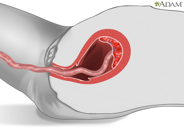 El alumbramiento de la placenta 