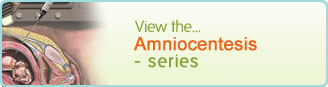 Amniocentesis - series