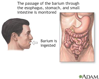 Barium ingestion - Illustration Thumbnail              