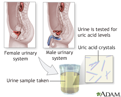 uric acid crystals in urine