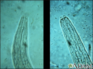 CDC - DPDx - Intestinal Hookworm