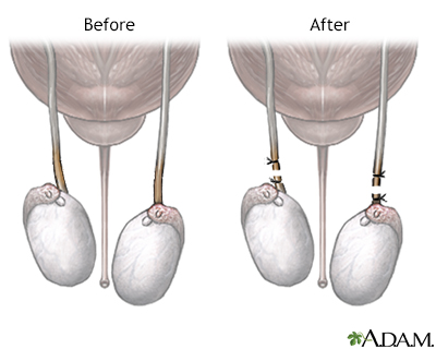 Before and after vasectomy - Illustration Thumbnail
                      