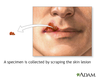 Herpes viral culture of lesion Information