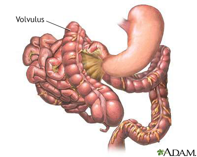 Volvulus - Illustration Thumbnail
              