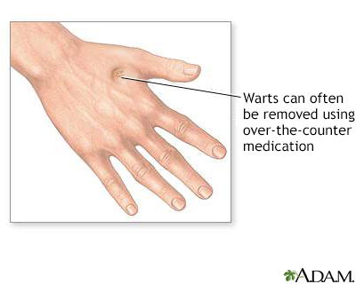 black warts on hands