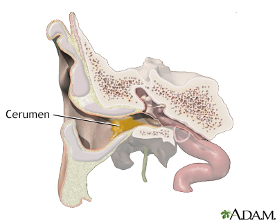 Ear wax Information Mount Sinai New York