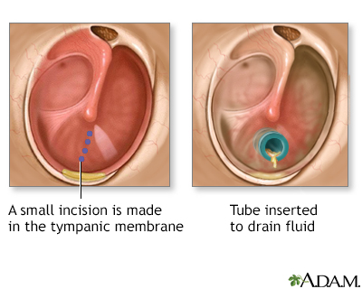 ruptured eardrum drainage