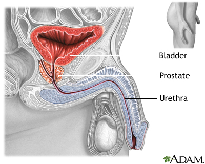glanda prostatică este mărită prostatitis symptoms