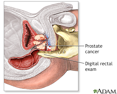 Prostate cancer - Illustration Thumbnail
              