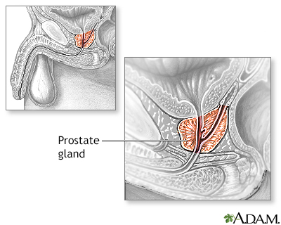 Enlarged prostate Information Mount Sinai New York