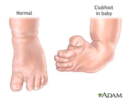 clubfoot deformity measurements x ray