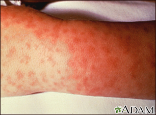 Rocky mountain spotted fever, lesions on arm - Illustration Thumbnail
                      