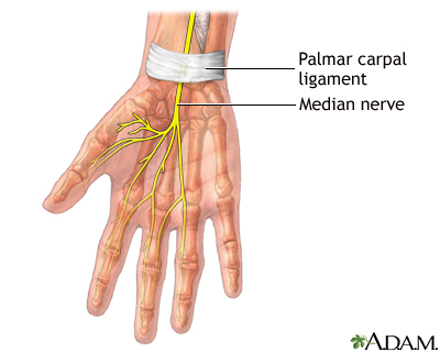 Carpal tunnel release Information