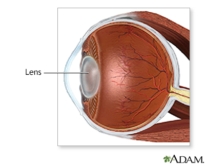 Cataract removal Information | Mount Sinai - New York