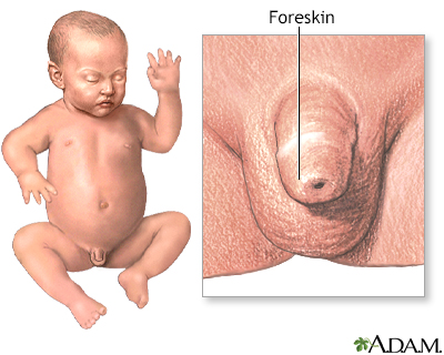 baby circumcision pictures