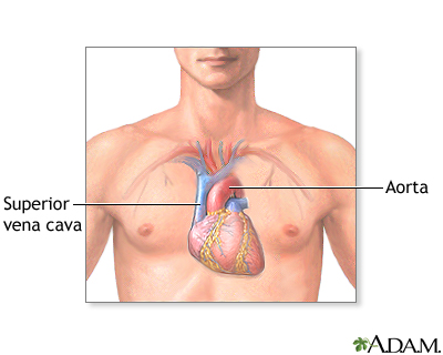 Heart transplant  - series - Illustration Thumbnail              